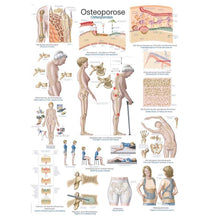 Anatomische Lehrtafel zur Osteoporose mit Skelett- und Wirbelsäulen-Illustrationen