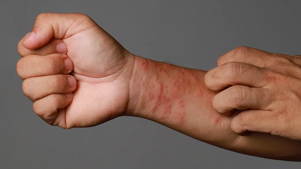 Close-up of a male wrist with a severe red skin rash