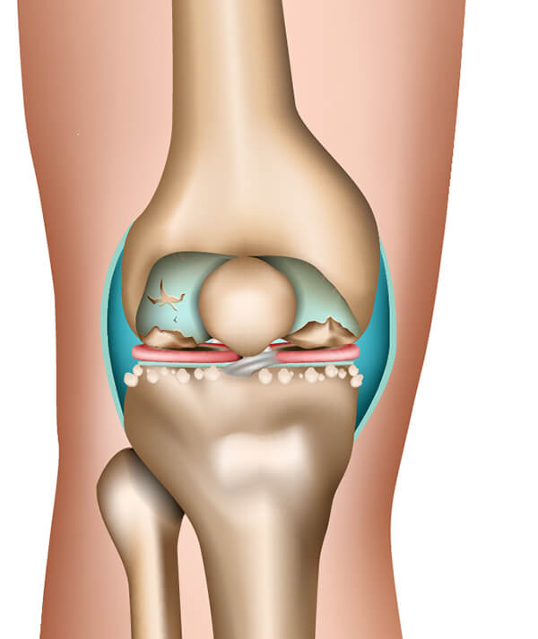 The stages of osteoarthritis in the example of the knee joint (4th phase)