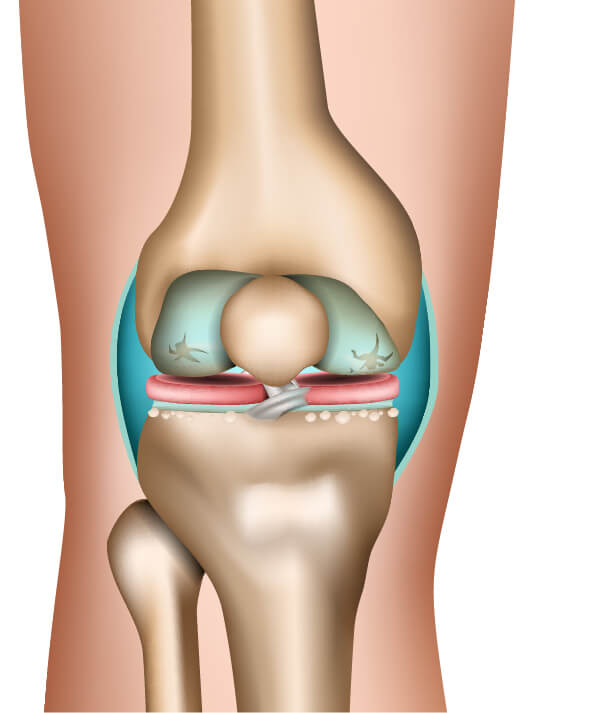 The stages of osteoarthritis in the example of the knee joint (3rd phase)