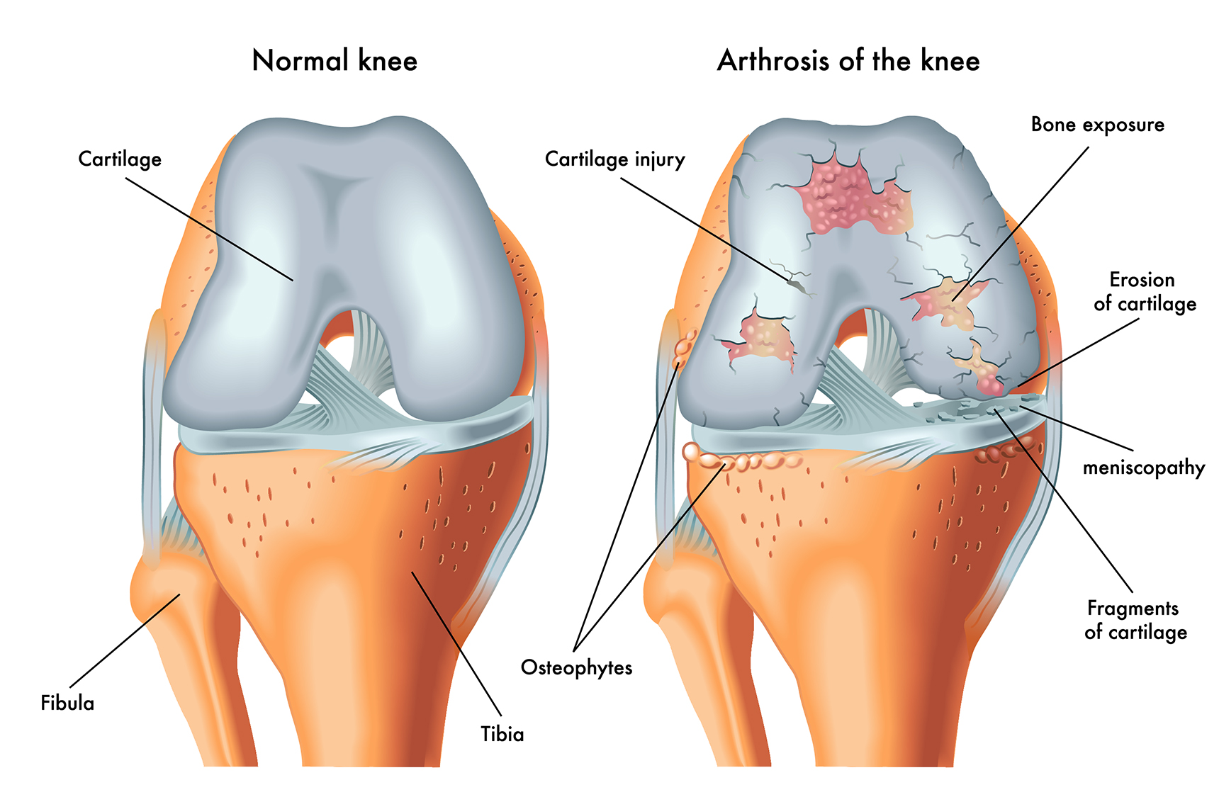 A healthy knee joint compared to an arthritic, severely damaged knee