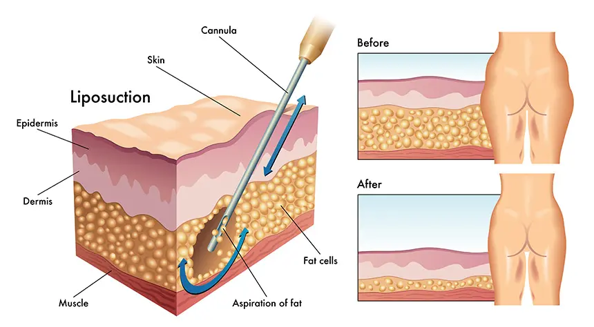 Graphical representation of liposuction