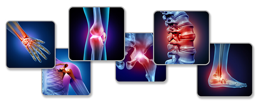 Osteoarthritis can affect virtually all joints in the body