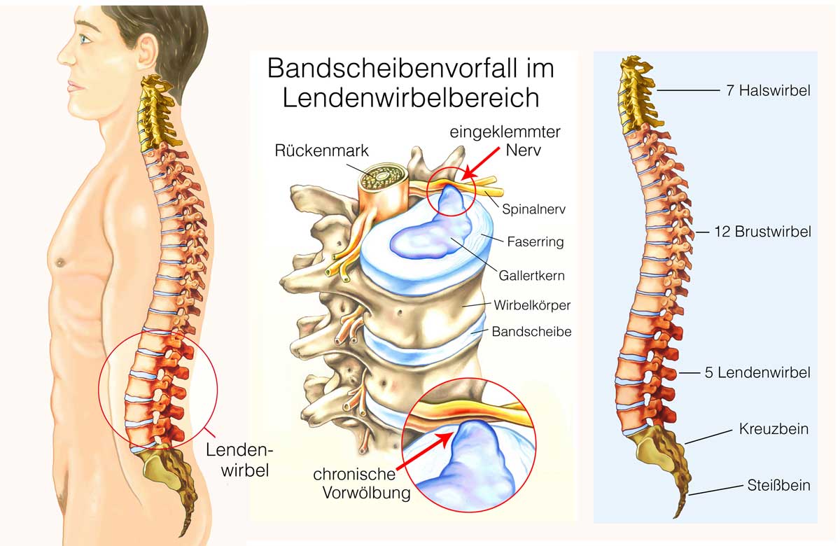 Grafik austretende Gallertkern der Bandscheibe auf die Nerven drückt