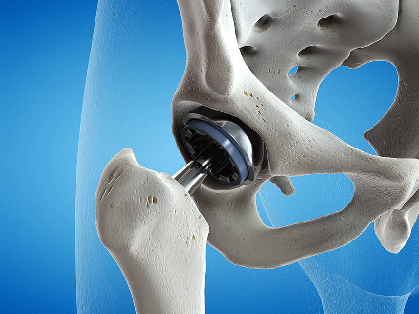 Graphic representation of a hip prosthesis as it may be necessary in coxarthrosis