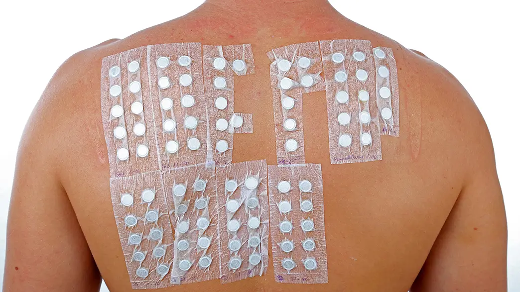 For an allergy test for contact allergies, numerous patches are applied to a patient's back