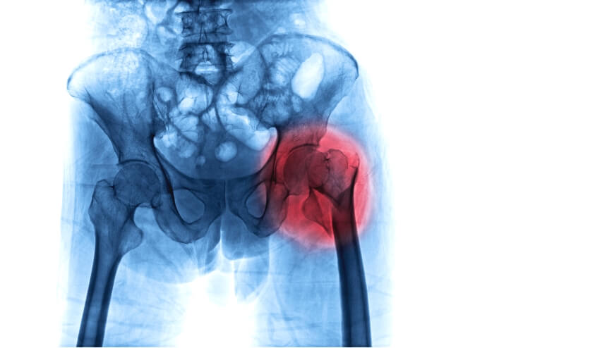 Femoral neck fracture after a fall in X-ray image