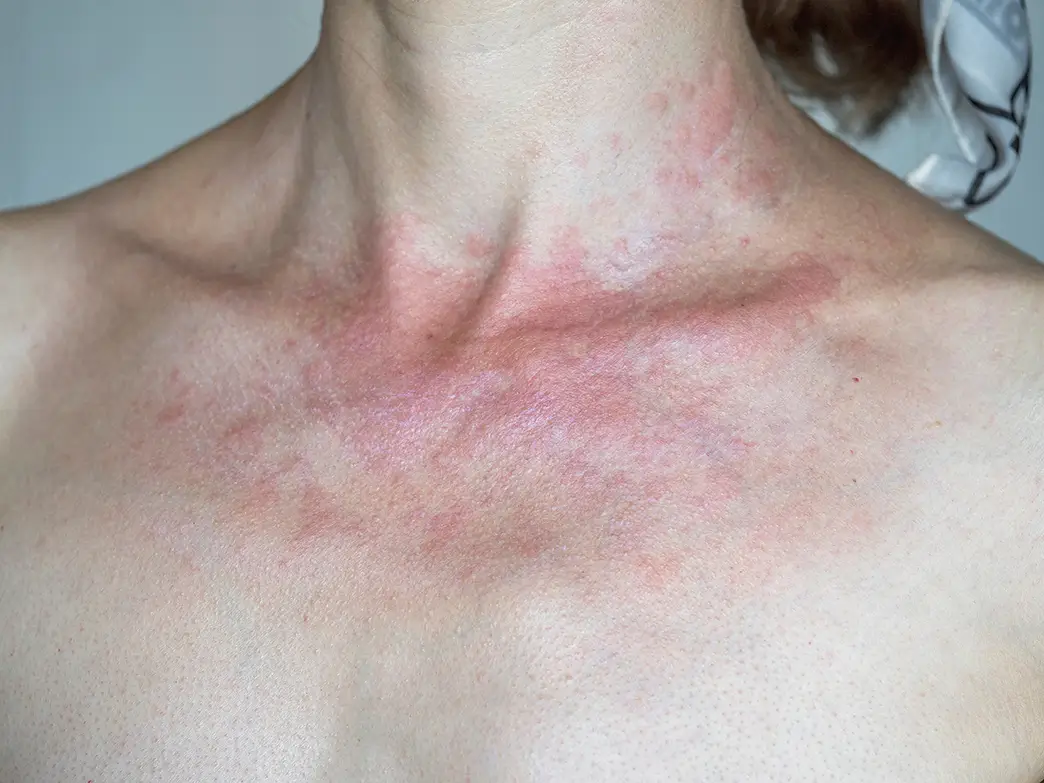 Woman with reddened and swollen skin due to sun allergy in the neck area