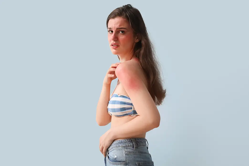 Young woman with skin reddened by sun allergy on her upper arm and face