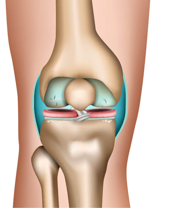 The stages of osteoarthritis in the example of the knee joint (2nd phase)